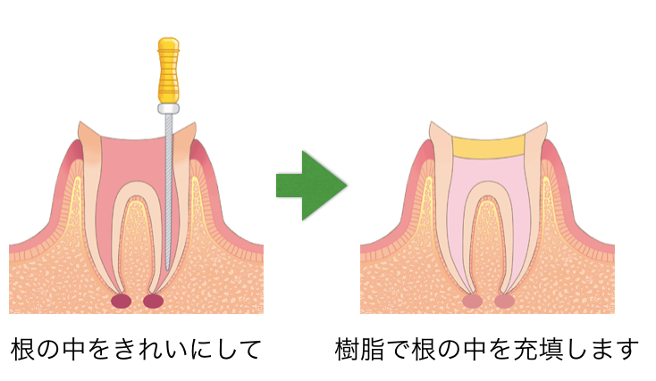 歯の根の治療