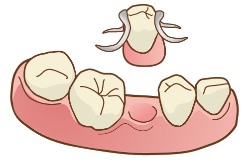 部分床義歯