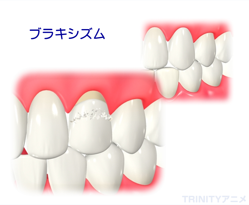 ブラキシズムのイラスト