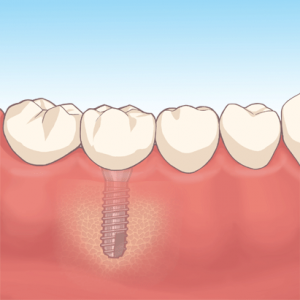 インプラント