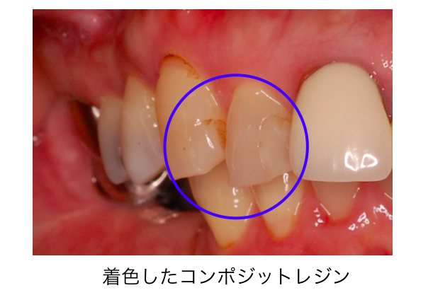 コンポジットレジン著色