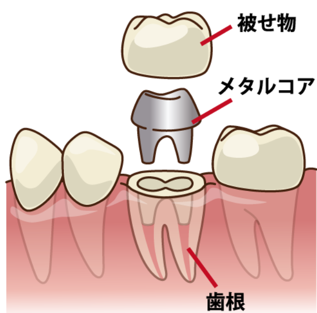 メタルコア