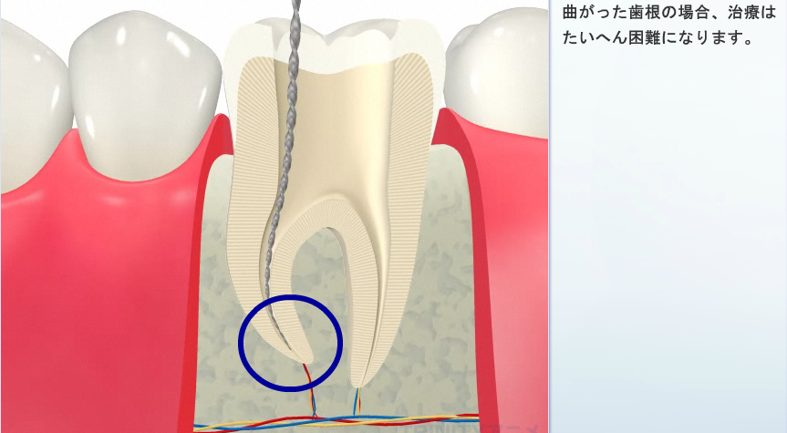 根管治療