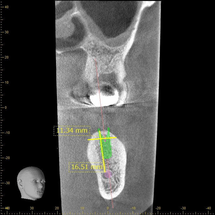 インプラントのCT画像