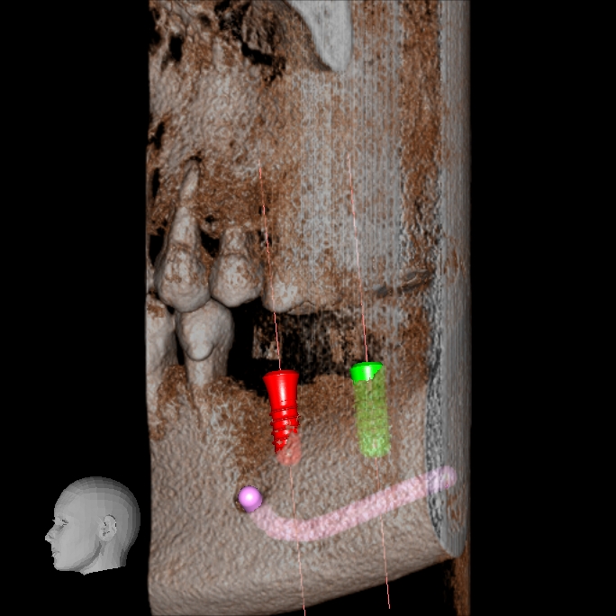 インプラントCT下歯槽神経