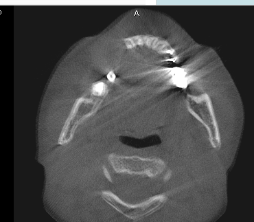 インプラントCTアーチファクト