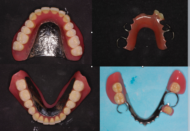 部分床入れ歯