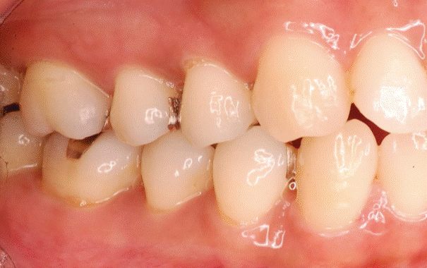 術後歯周病口腔内写真