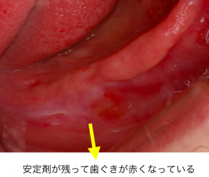 入れ歯安定材の歯ぐきの炎症