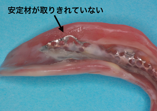 入れ歯安定材取り残し