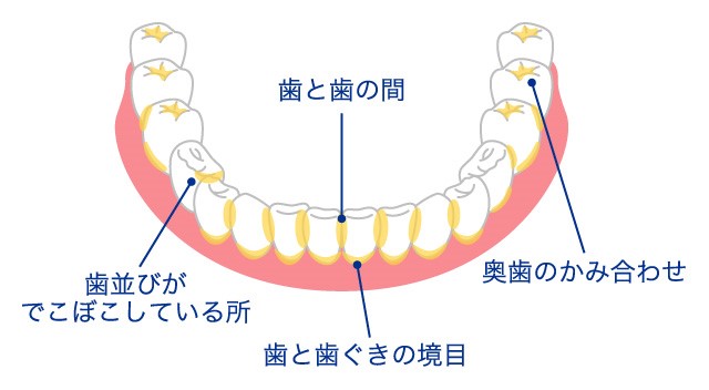 磨き残しの多い場所