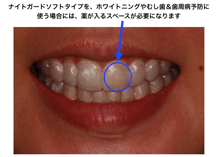 ナイトガード　ホワイトニング