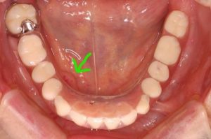 入れ歯　口腔内の傷
