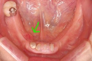 入れ歯　口腔内の傷