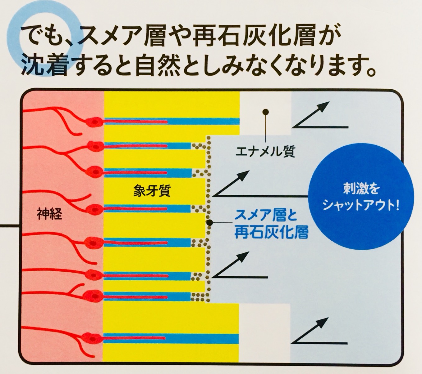 スメア層と再石灰化層