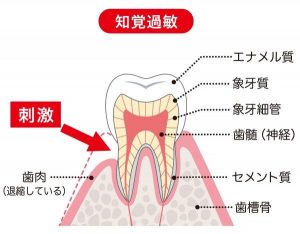 知覚過敏のメカニズム