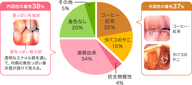 歯　着色　原因