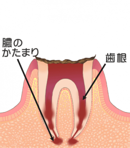 根尖性歯周炎