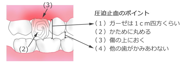 圧迫止血