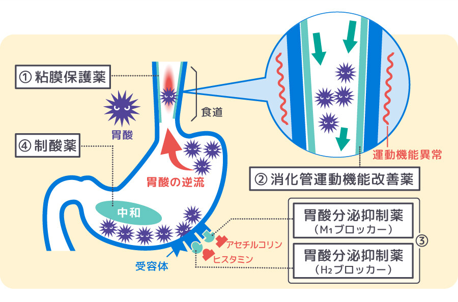 逆流性食道炎