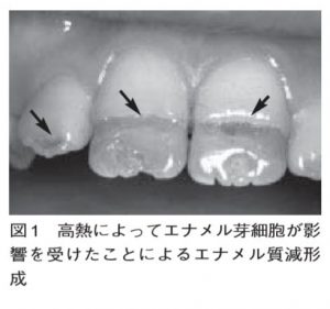 エナメル質減形成