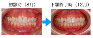 マウスピース矯正比較