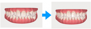インビザラインケースアセスメント