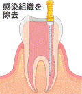 歯のイラスト