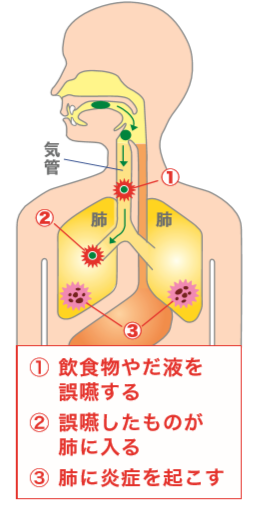 誤嚥性肺炎