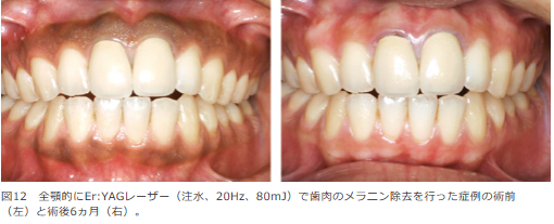 レーザーメラニン除去