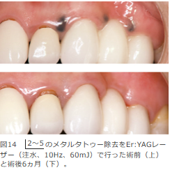 メタルタトゥー除去 YAG レーザー