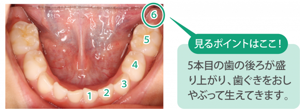 ６歳臼歯