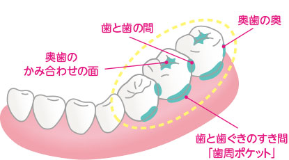 磨き残し